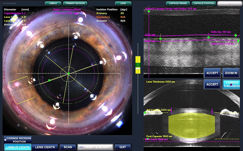 LenSx Femtosecond Laser Snead Eye Group