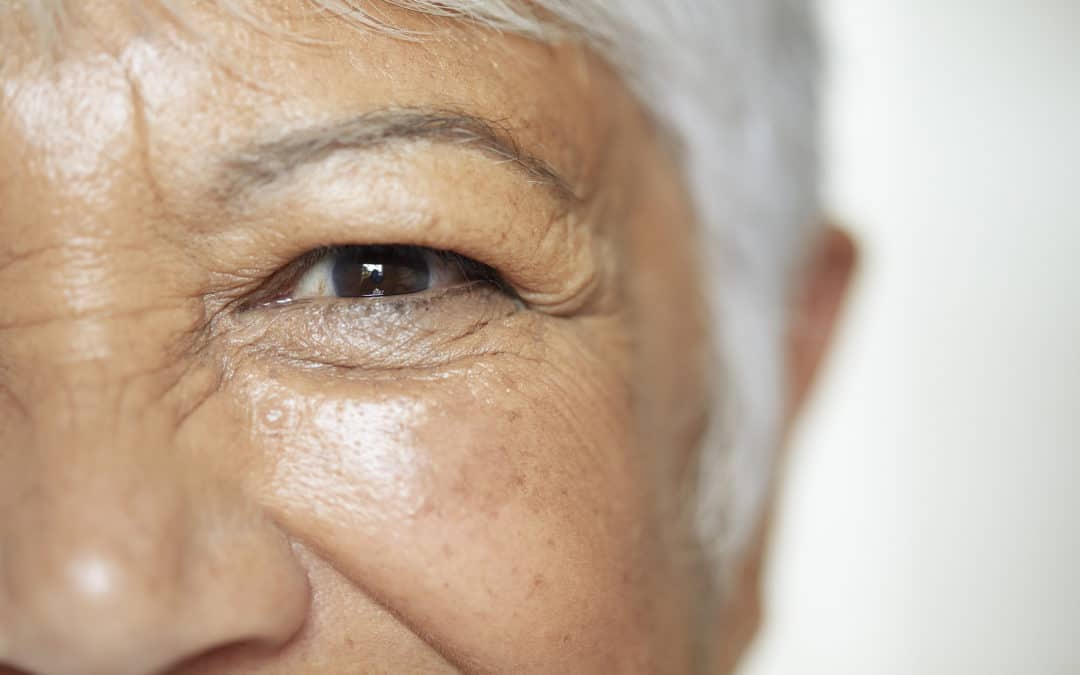 How Long Does it Take to See Clearly After Cataract Surgery?